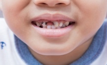 Çocuklarınızın Dişleri Risk Altında! Nasıl Koruma Sağlanır