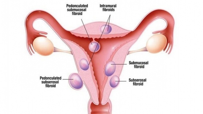 Uterin Fibroidler Hakkında Bilmeniz Gerekenler