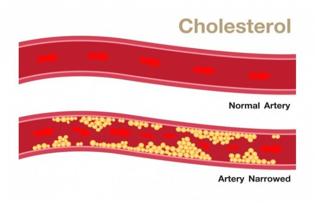 İlaç Kullanmadan Kolesterolünüzü Nasıl Azaltabilirsiniz?